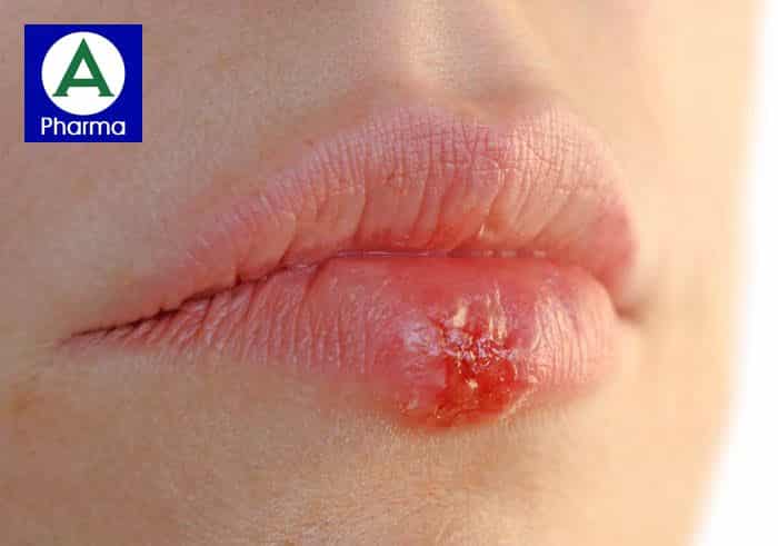 Acyclovir Stada Cream 5G có thể điều trị Herpes môi và nhiều bệnh ngoài da khác