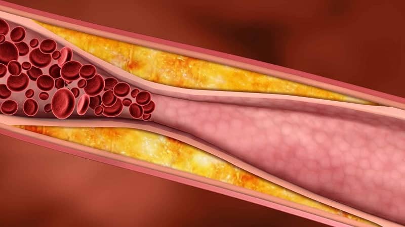 Cholesterol cao gây ra bệnh xơ vữa động mạch